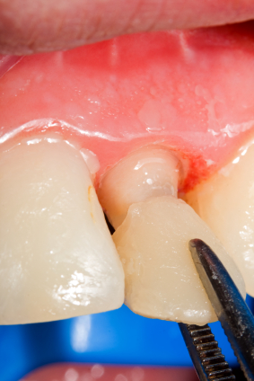 How to Properly Care for New Dental Veneers