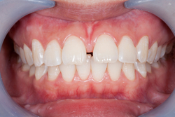 Restorative Options When You Have Gaps Between Your Teeth
