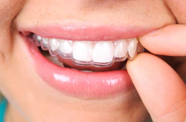 Woman using a clear aligner