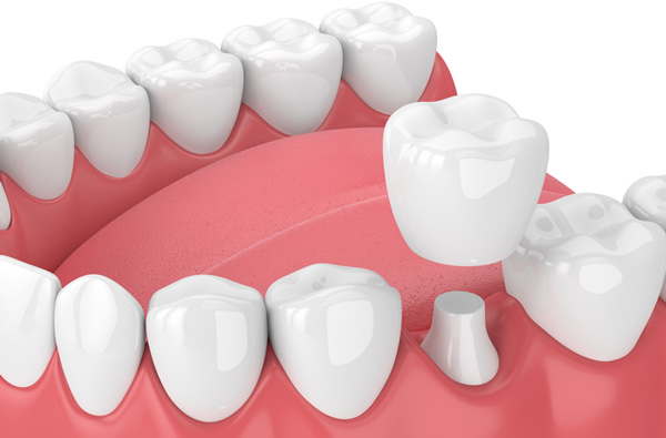 Rendering of jaw with dental crown